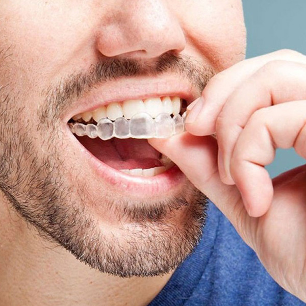 ALINHADORES INVISALIGN